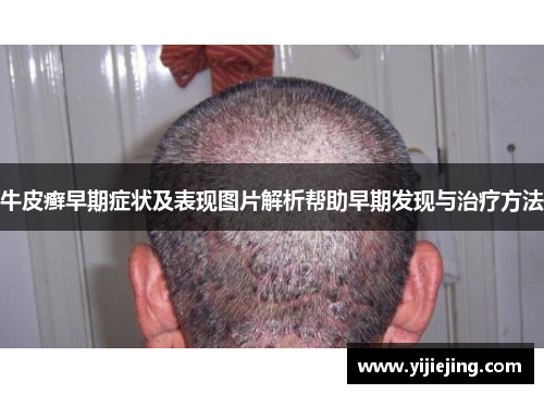 牛皮癣早期症状及表现图片解析帮助早期发现与治疗方法
